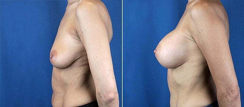 Breast Augmentation Before & After