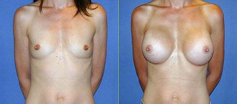 Breast Augmentation Before & After