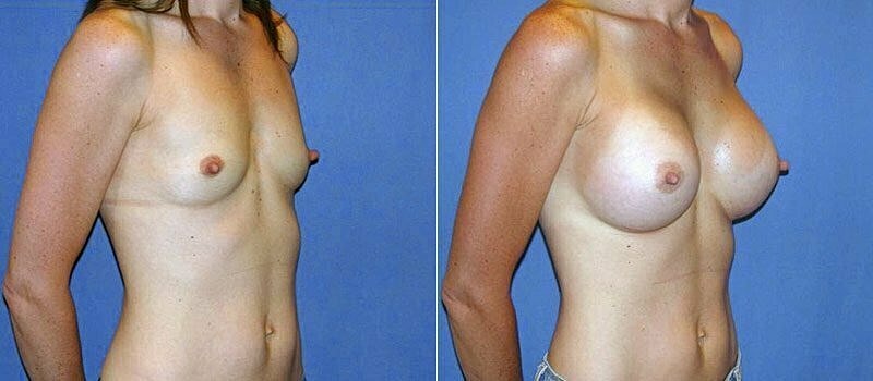 Breast Augmentation Before & After