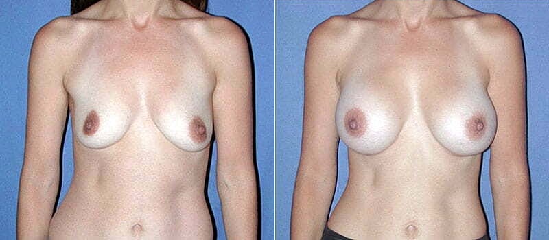 Breast Augmentation Before & After
