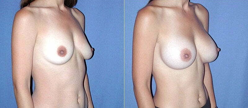 Breast Augmentation Before & After