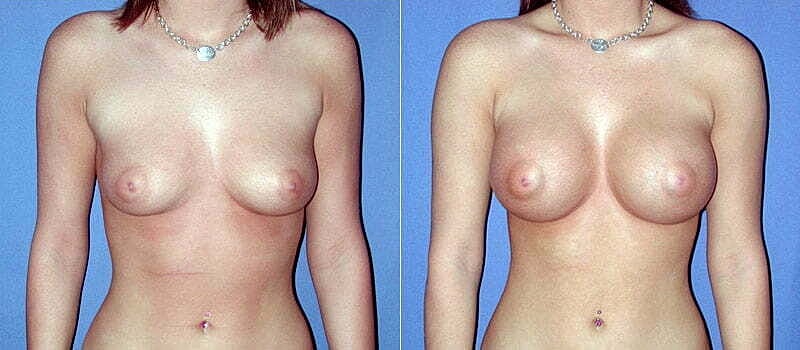 Breast Augmentation Before & After