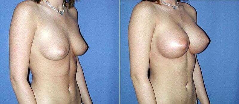 Breast Augmentation Before & After
