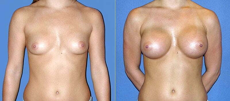 Breast Augmentation Before & After