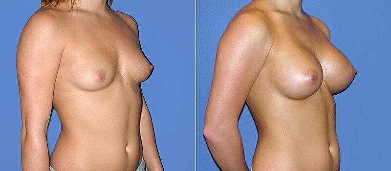 Breast Augmentation Before & After