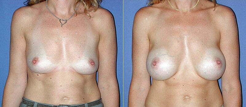 Breast Augmentation Before & After