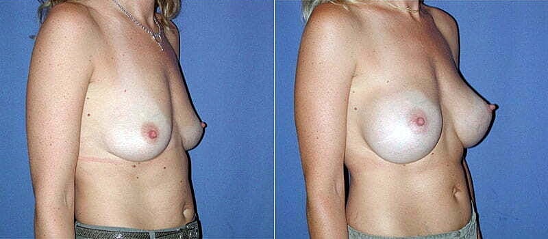 Breast Augmentation Before & After