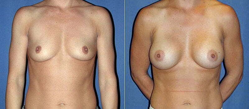 Breast Augmentation Before & After