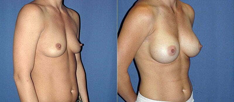 Breast Augmentation Before & After