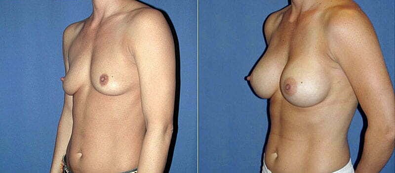 Breast Augmentation Before & After