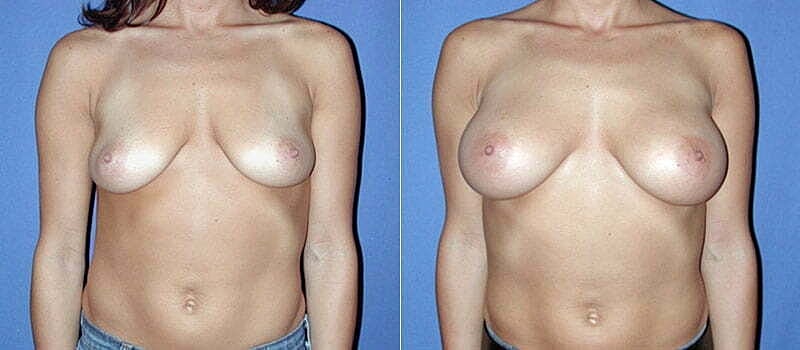Breast Augmentation Before & After