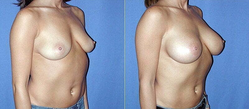 Breast Augmentation Before & After