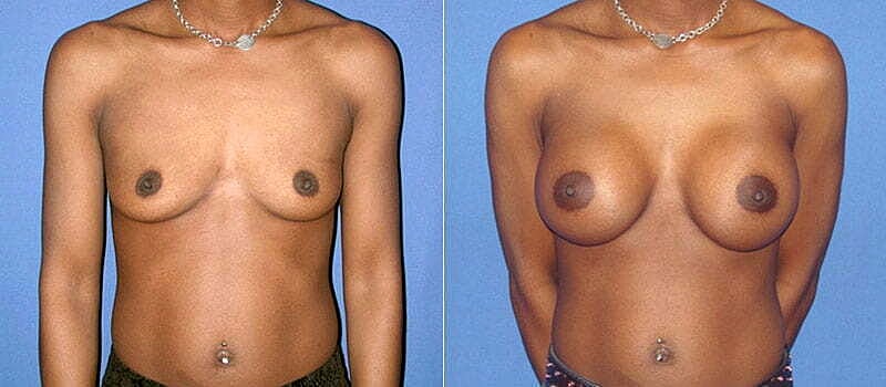Breast Augmentation Before & After