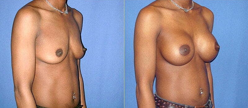 Breast Augmentation Before & After