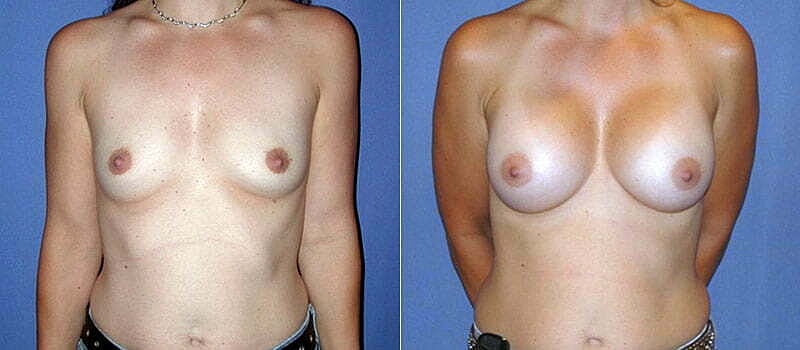 Breast Augmentation Before & After