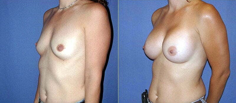 Breast Augmentation Before & After