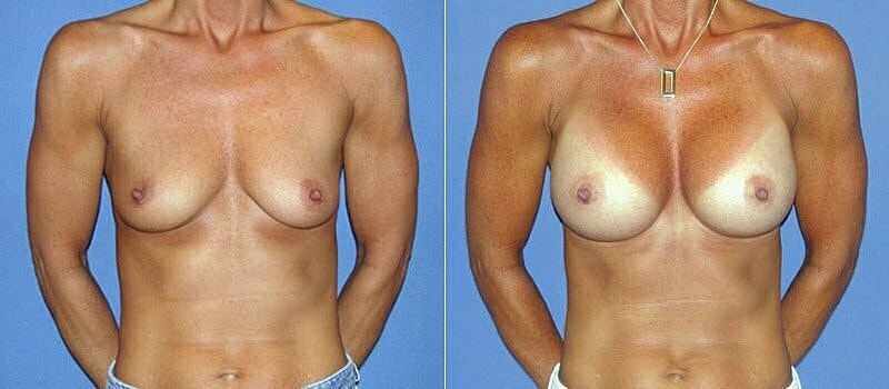 Breast Augmentation Before & After