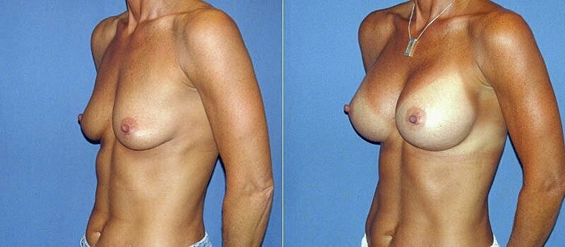 Breast Augmentation Before & After