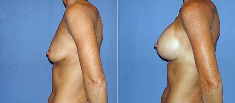 Breast Augmentation Before & After