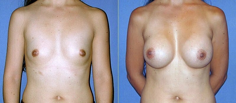 Breast Augmentation Before & After
