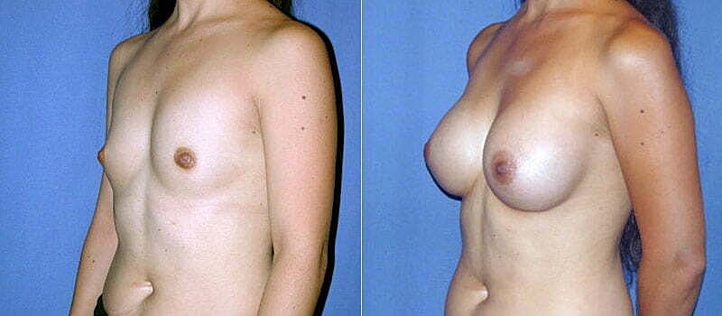 Breast Augmentation Before & After