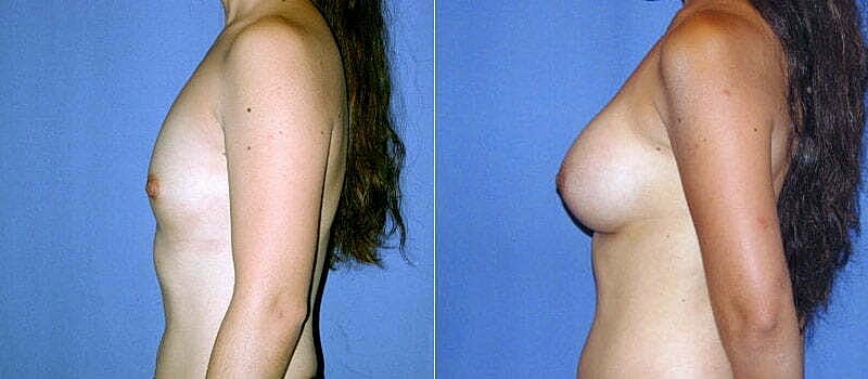 Breast Augmentation Before & After
