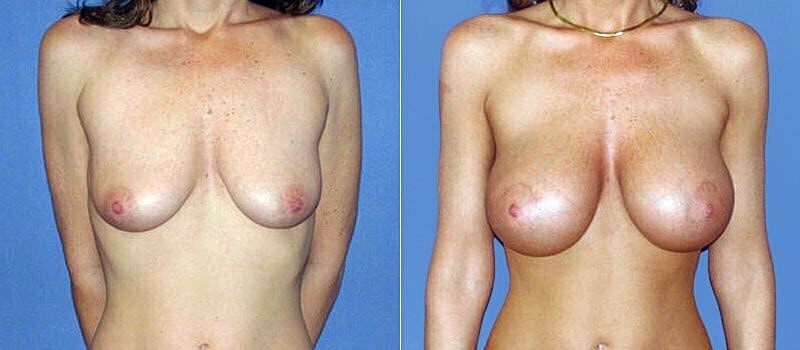 Breast Augmentation Before & After