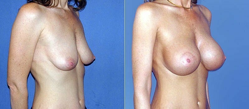 Breast Augmentation Before & After