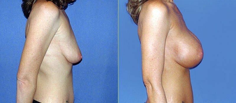 Breast Augmentation Before & After