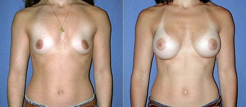 Breast Augmentation Before & After