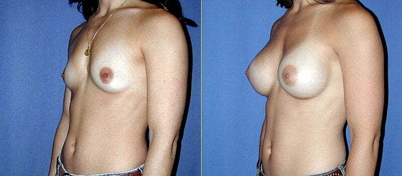Breast Augmentation Before & After
