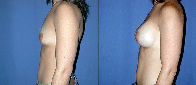 Breast Augmentation Before & After