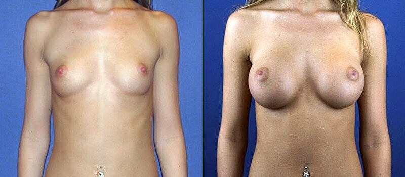 Breast Augmentation Before & After