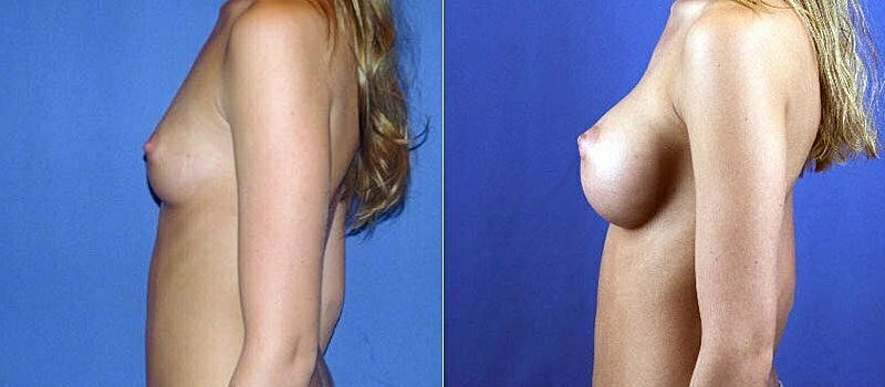 Breast Augmentation Before & After