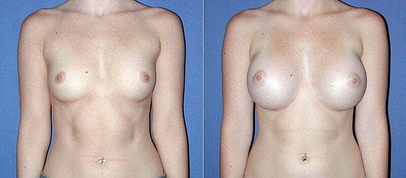 Breast Augmentation Before & After
