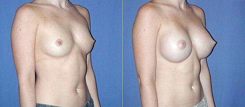 Breast Augmentation Before & After