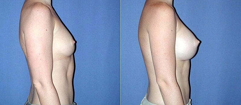 Breast Augmentation Before & After