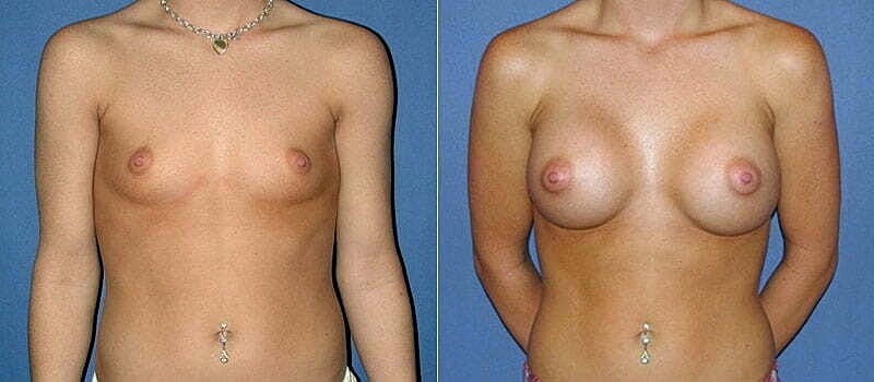 Breast Augmentation Before & After