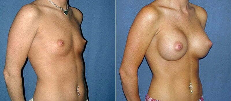 Breast Augmentation Before & After