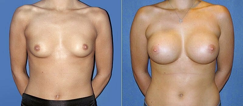 Breast Augmentation Before & After