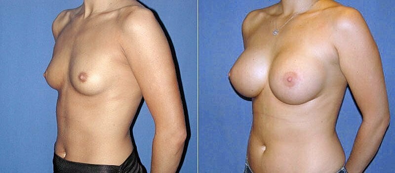 Breast Augmentation Before & After