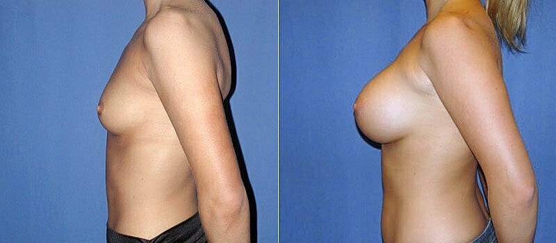 Breast Augmentation Before & After