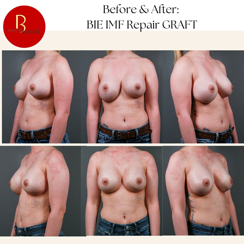 Secondary Revision Before & After