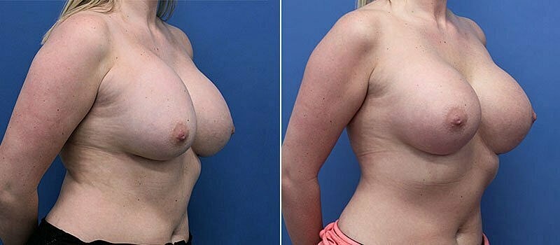 Secondary Revision Before & After