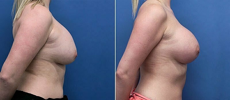 Secondary Revision Before & After