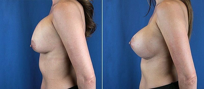 Secondary Revision Before & After