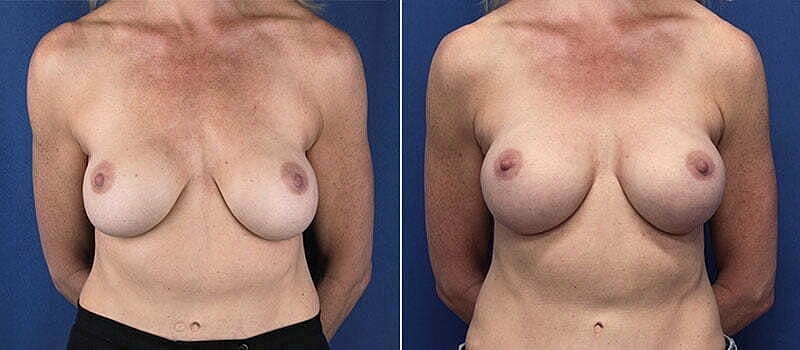 Secondary Revision Before & After