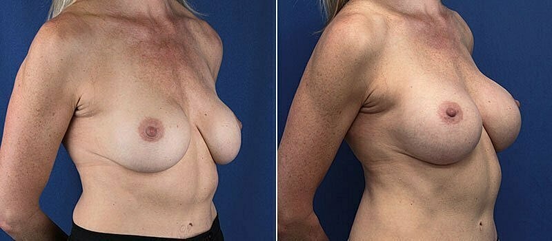 Secondary Revision Before & After