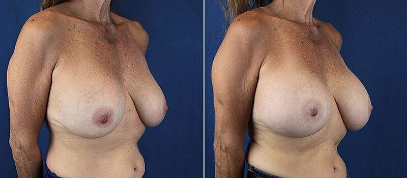 Secondary Revision Before & After