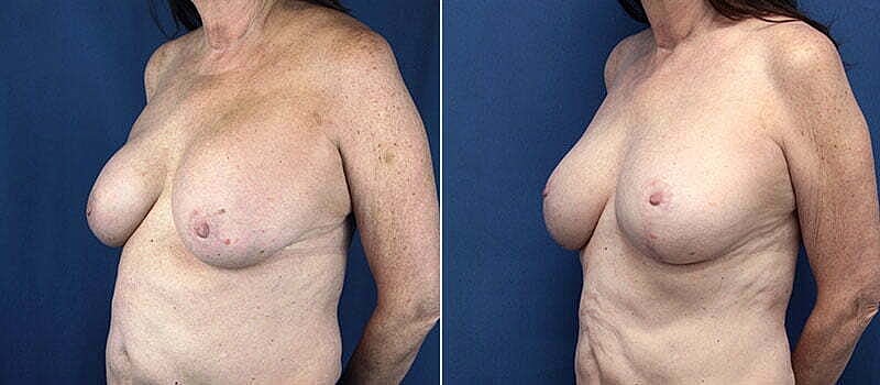 Secondary Revision Before & After